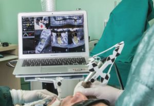 chirurgia implantare 3d guidata