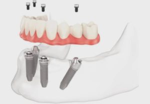 impianti dentali all-on-four