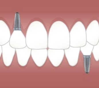 impianti denti Bologna