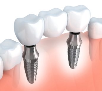 impianto dentale e ponte