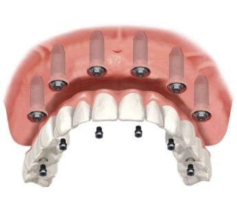 protesi dentali bologna