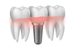 Dentista Vergaro Bologna: implantologia