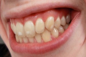 Dentista Vergaro Bologna: parodontologia